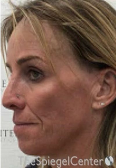 CO2 Laser Before & After Gallery - Patient 415328 - Image 3