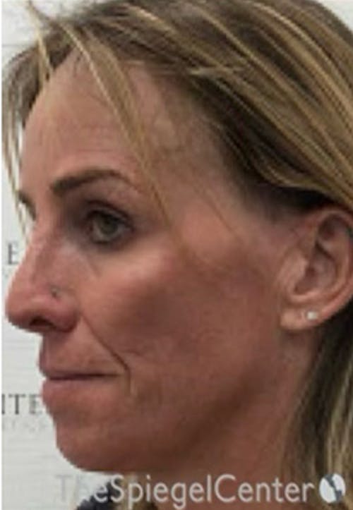CO2 Laser Before & After Gallery - Patient 415328 - Image 3