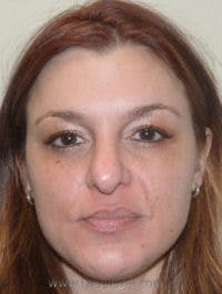 CO2 Laser Before & After Gallery - Patient 355017 - Image 1