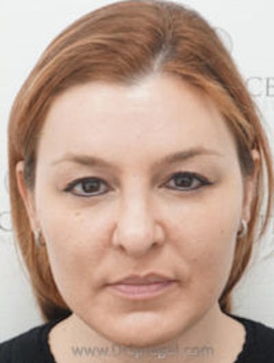 CO2 Laser Before & After Gallery - Patient 355017 - Image 2