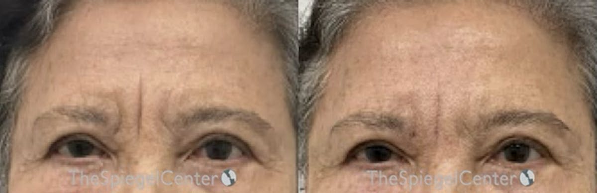 Deep 11 Before & After Gallery - Patient 240778 - Image 1