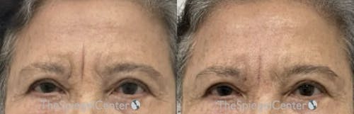 Deep 11 Before & After Gallery - Patient 240778 - Image 1