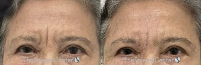 Deep 11 Before & After Gallery - Patient 240778 - Image 1