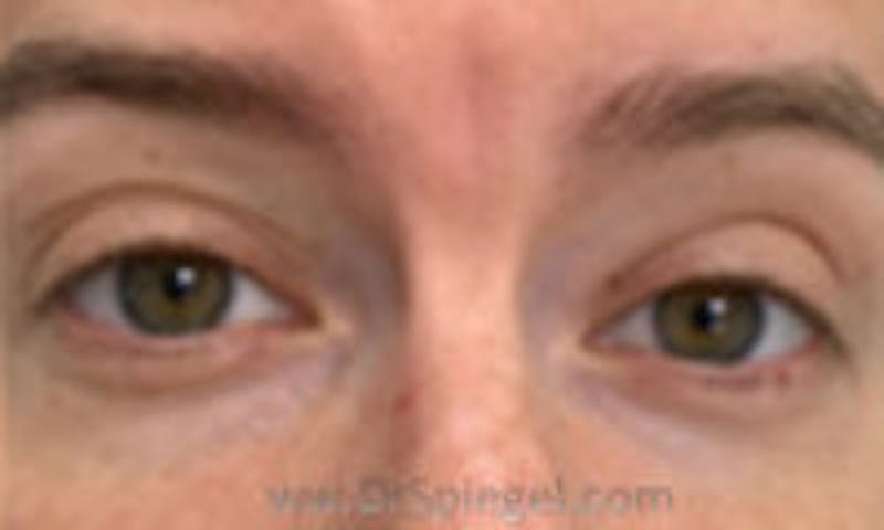 Deep 11 Before & After Gallery - Patient 127961 - Image 1