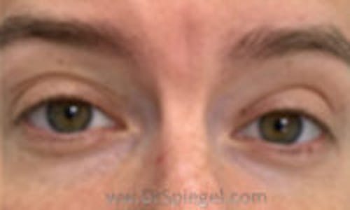 Deep 11 Before & After Gallery - Patient 127961 - Image 1