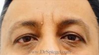 Deep 11 Before & After Gallery - Patient 301530 - Image 1