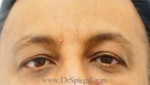 Deep 11 Before & After Gallery - Patient 301530 - Image 2