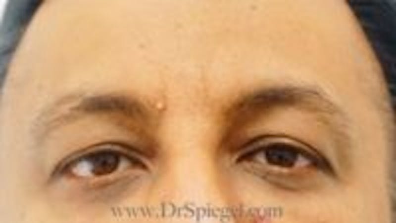 Deep 11 Before & After Gallery - Patient 301530 - Image 2