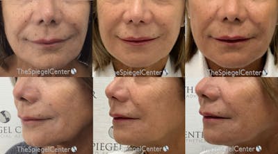 Ellacor Before & After Gallery - Patient 390135 - Image 1