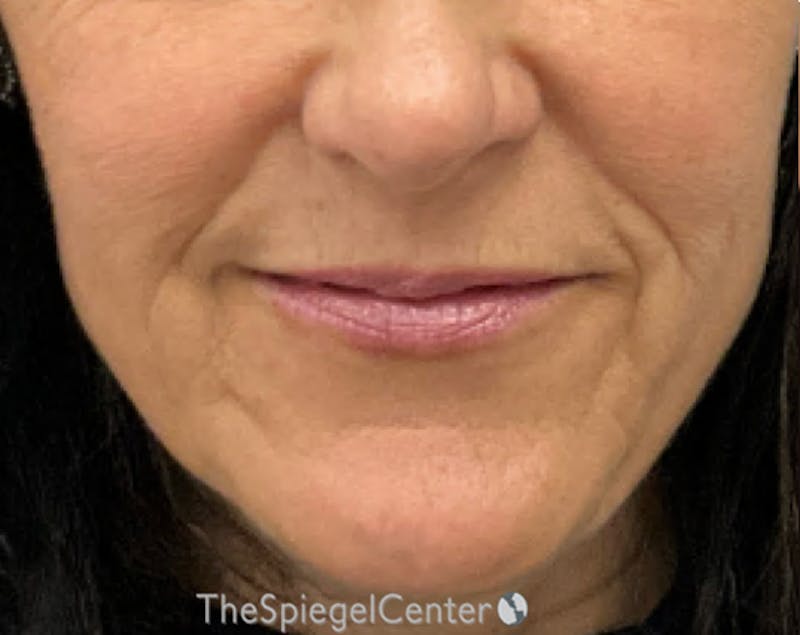 Ellacor Before & After Gallery - Patient 350044 - Image 1