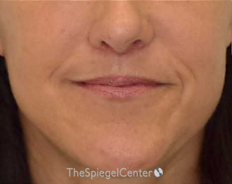 Ellacor Before & After Gallery - Patient 350044 - Image 2