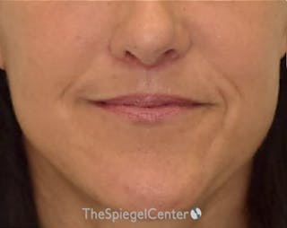 Ellacor Before & After Gallery - Patient 350044 - Image 2