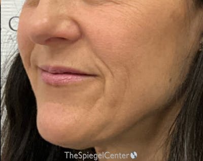 Ellacor Before & After Gallery - Patient 350044 - Image 3