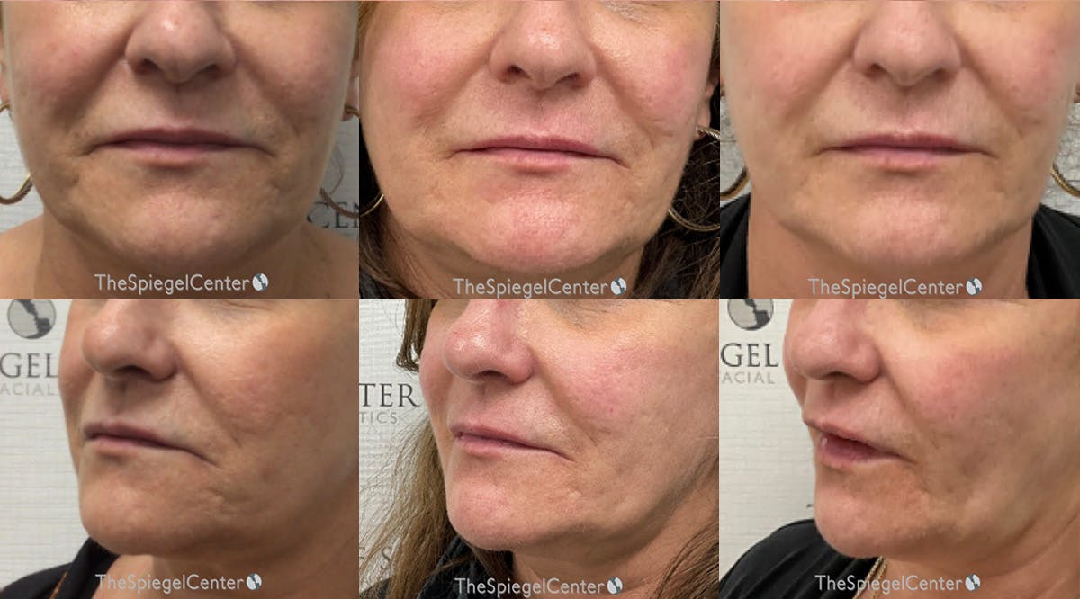 Ellacor Before & After Gallery - Patient 267673 - Image 1