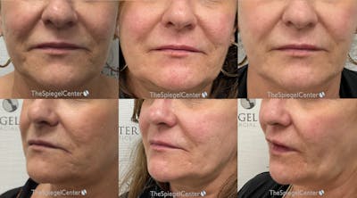 Ellacor Before & After Gallery - Patient 267673 - Image 1