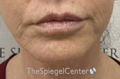 Ellacor Before & After Gallery - Patient 250358 - Image 1