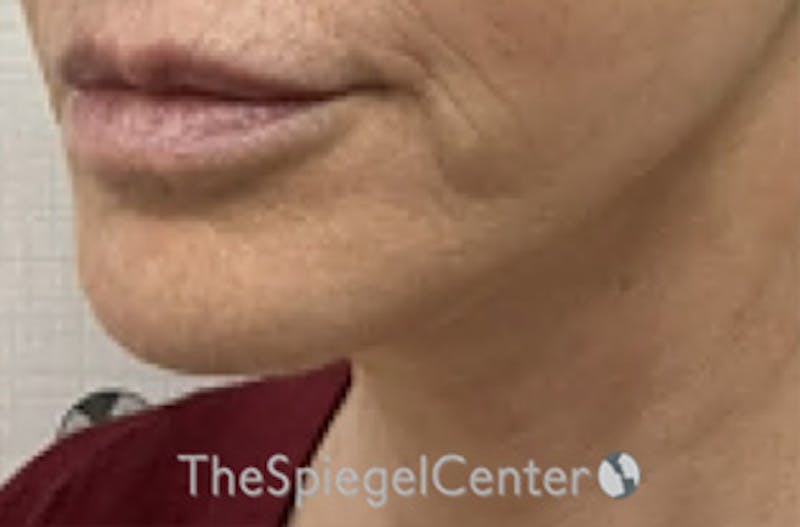 Ellacor Before & After Gallery - Patient 250358 - Image 3