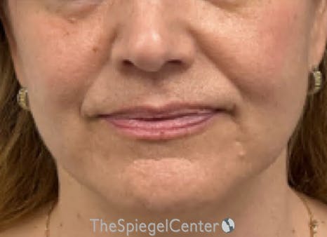 Ellacor Before & After Gallery - Patient 139272 - Image 1