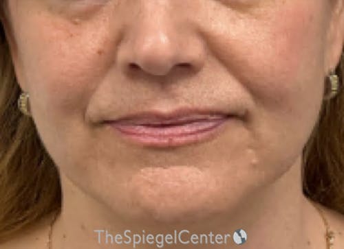 Ellacor Before & After Gallery - Patient 139272 - Image 1