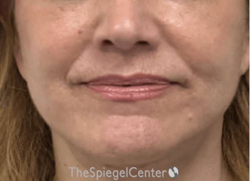 Ellacor Before & After Gallery - Patient 139272 - Image 2