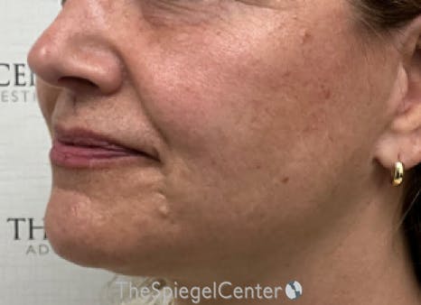 Ellacor Before & After Gallery - Patient 139272 - Image 3