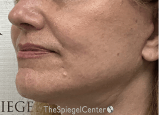 Ellacor Before & After Gallery - Patient 139272 - Image 4