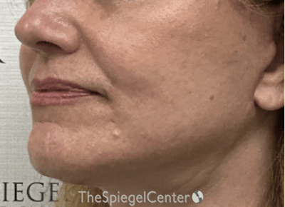 Ellacor Before & After Gallery - Patient 139272 - Image 4