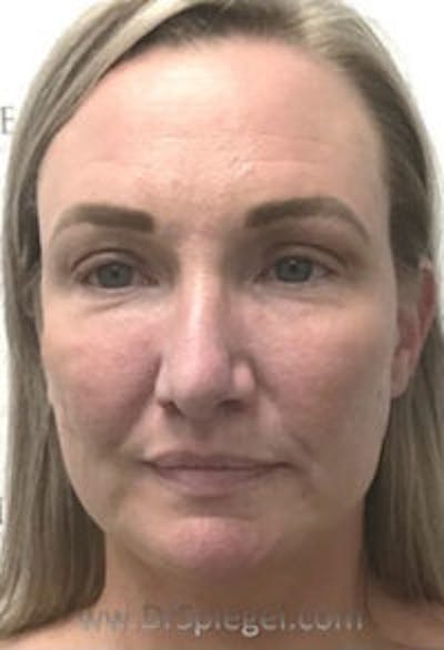 Facetite / Necktite / Embrace / Accutite Before & After Gallery - Patient 387415 - Image 2