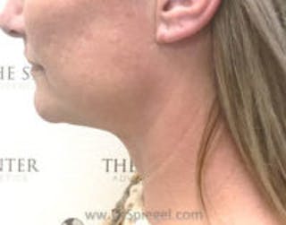 Facetite / Necktite / Embrace / Accutite Before & After Gallery - Patient 387415 - Image 6