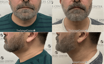 Facetite / Necktite / Embrace / Accutite Before & After Gallery - Patient 569297 - Image 1