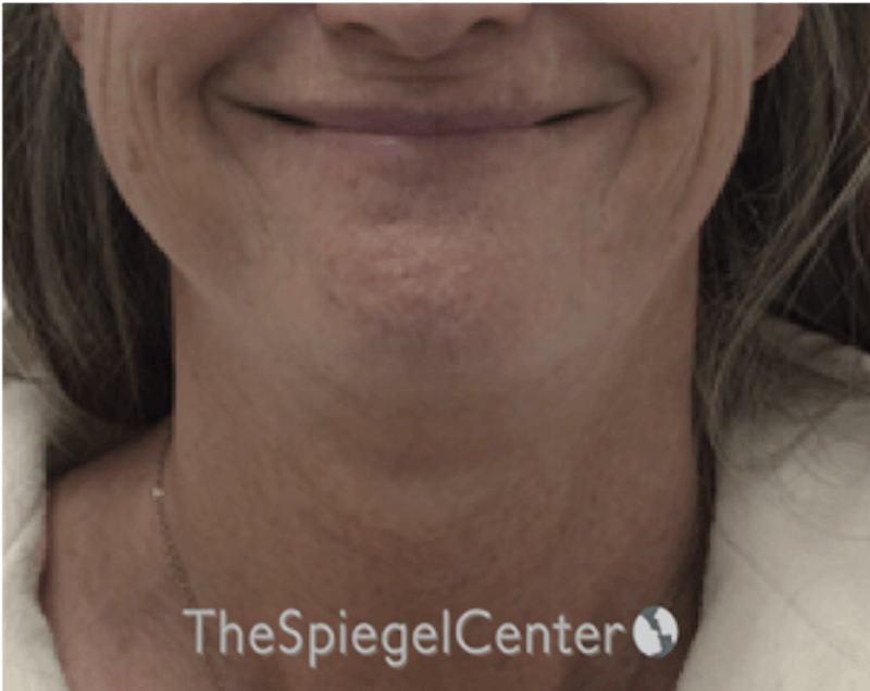 Facetite / Necktite / Embrace / Accutite Before & After Gallery - Patient 791916 - Image 1