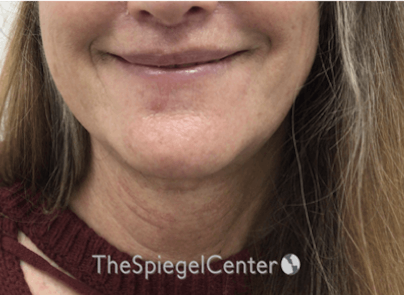 Facetite / Necktite / Embrace / Accutite Before & After Gallery - Patient 791916 - Image 2