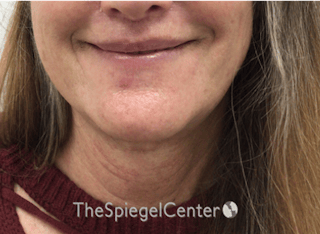 Facetite / Necktite / Embrace / Accutite Before & After Gallery - Patient 791916 - Image 2