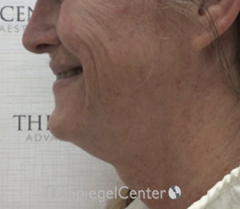 Facetite / Necktite / Embrace / Accutite Before & After Gallery - Patient 791916 - Image 3