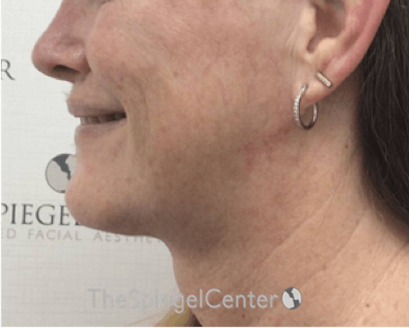 Facetite / Necktite / Embrace / Accutite Before & After Gallery - Patient 791916 - Image 4