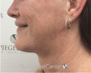 Facetite / Necktite / Embrace / Accutite Before & After Gallery - Patient 791916 - Image 4