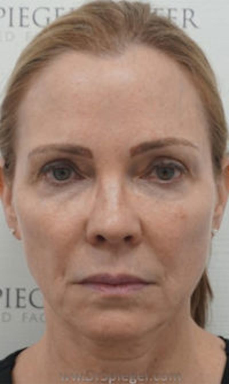 Facetite / Necktite / Embrace / Accutite Before & After Gallery - Patient 147286 - Image 1