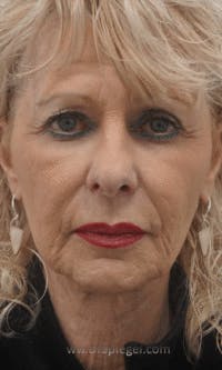 Facetite / Necktite / Embrace / Accutite Before & After Gallery - Patient 353675 - Image 1