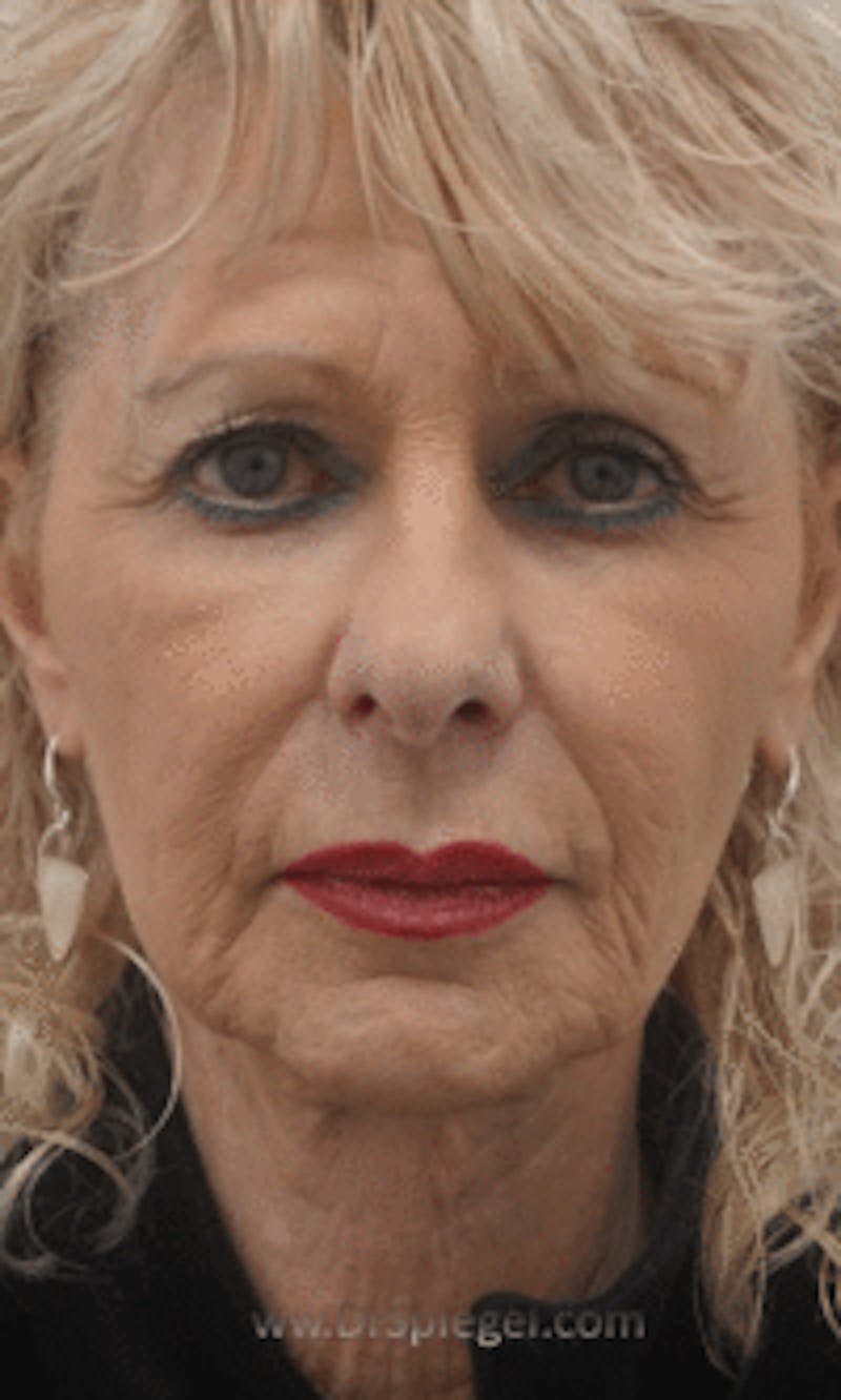 Facetite / Necktite / Embrace / Accutite Before & After Gallery - Patient 353675 - Image 1