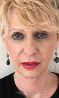 Facetite / Necktite / Embrace / Accutite Before & After Gallery - Patient 353675 - Image 2