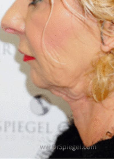 Facetite / Necktite / Embrace / Accutite Before & After Gallery - Patient 353675 - Image 3