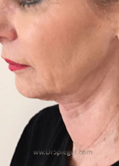 Facetite / Necktite / Embrace / Accutite Before & After Gallery - Patient 353675 - Image 4