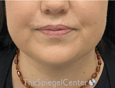 Facetite / Necktite / Embrace / Accutite Before & After Gallery - Patient 165676 - Image 2