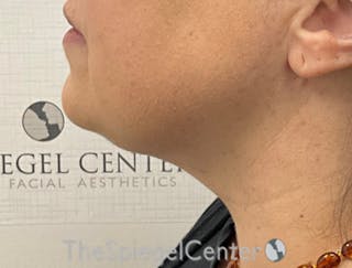 Facetite / Necktite / Embrace / Accutite Before & After Gallery - Patient 165676 - Image 4