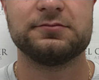 Facetite / Necktite / Embrace / Accutite Before & After Gallery - Patient 241133 - Image 1