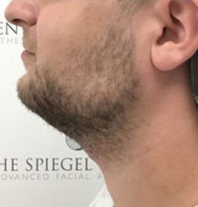 Facetite / Necktite / Embrace / Accutite Before & After Gallery - Patient 241133 - Image 3