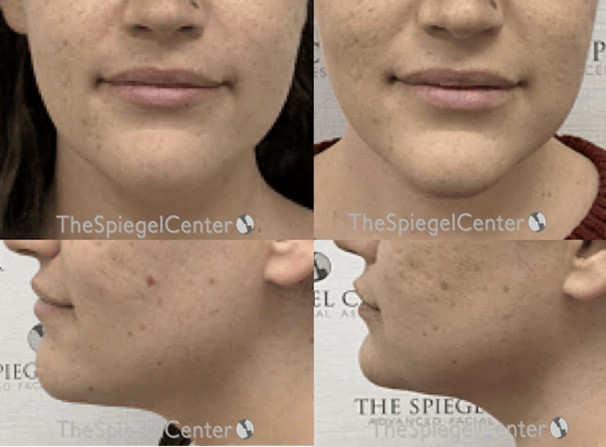 Facetite / Necktite / Embrace / Accutite Before & After Gallery - Patient 165134 - Image 1