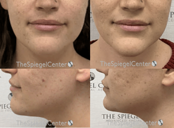 Facetite / Necktite / Embrace / Accutite Before & After Gallery - Patient 165134 - Image 1