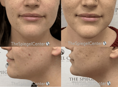 Facetite / Necktite / Embrace / Accutite Before & After Gallery - Patient 165134 - Image 1