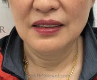 Facetite / Necktite / Embrace / Accutite Before & After Gallery - Patient 137555 - Image 1